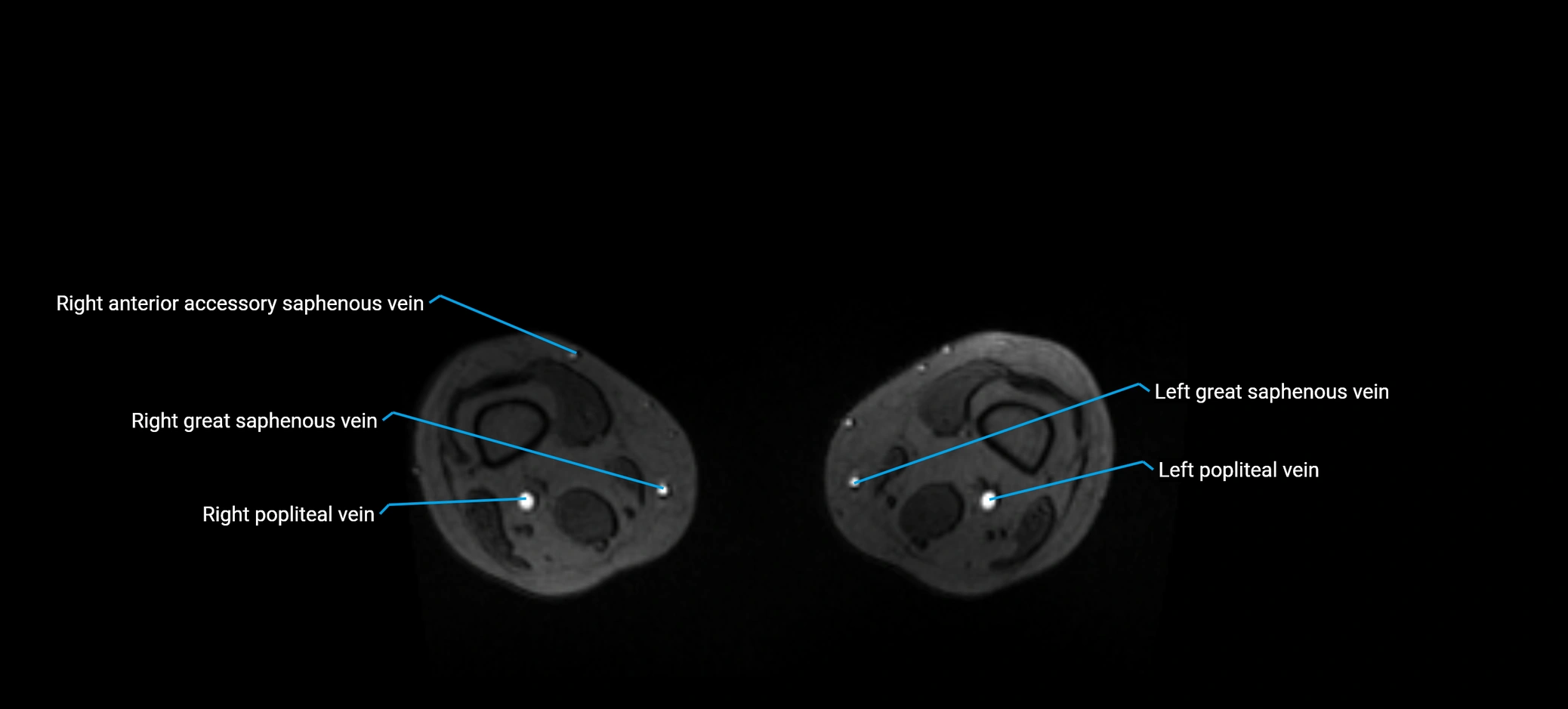 MRV abdomen pelvis & lower limb axial cross sectional anatomy labelled MRI image 343.webp